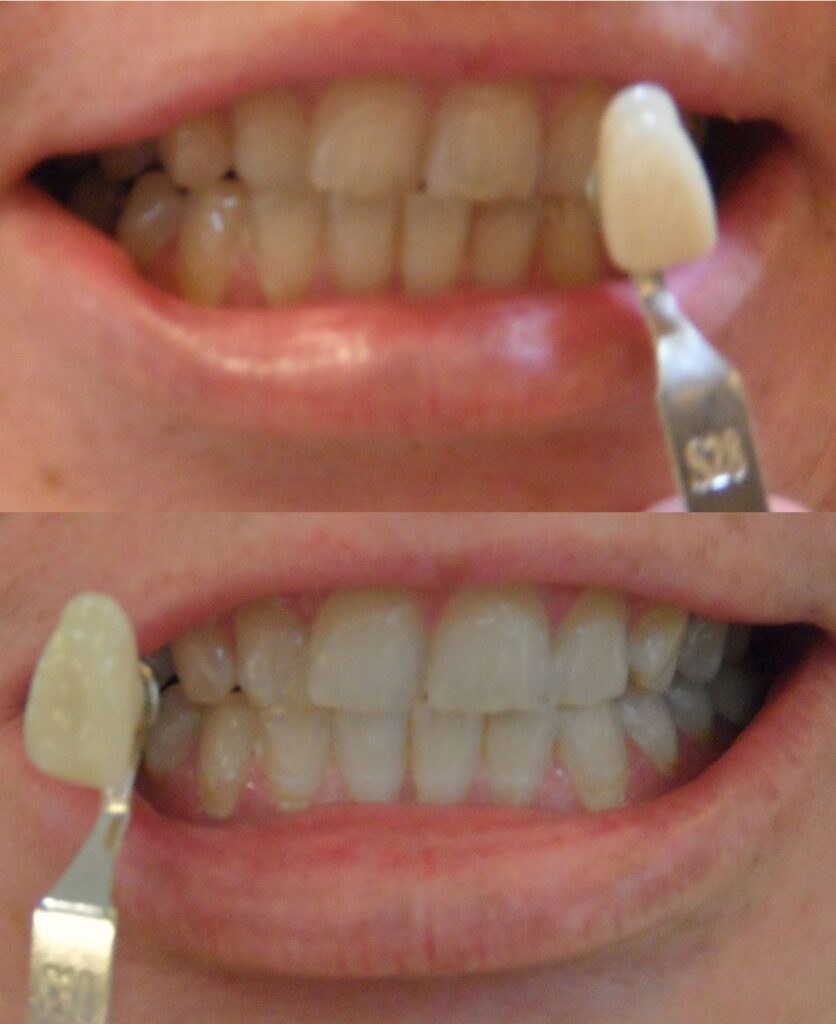 Teeth Whitening Bleach at Allure Salon