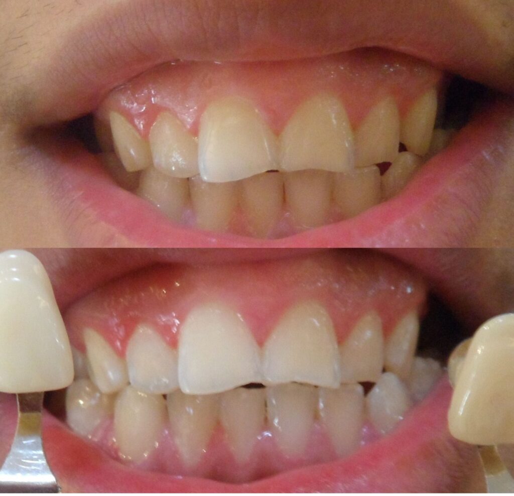 Best Teeth Treatment Bleach for White Teeth