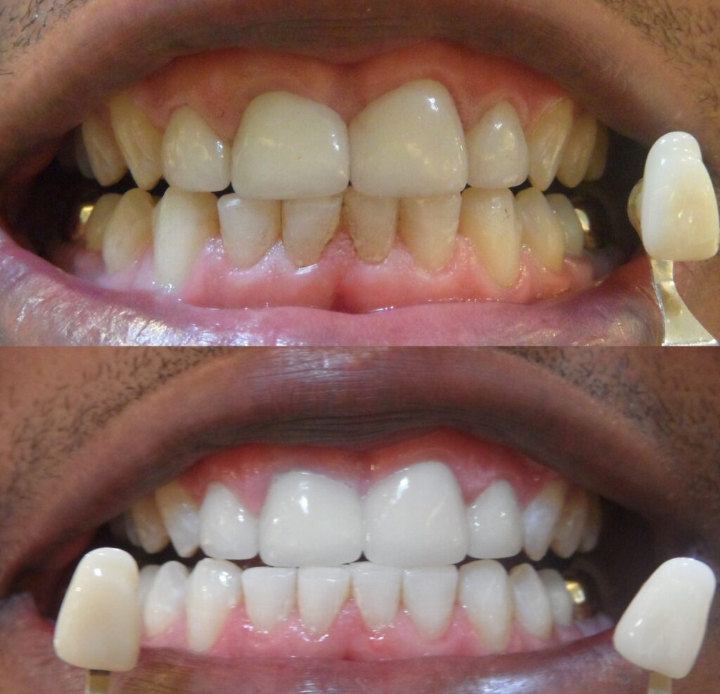 Teeth Whitening Before After at Allure Salon