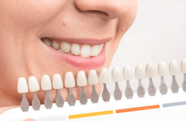 Get Whiter Teeth in Lubbock TX